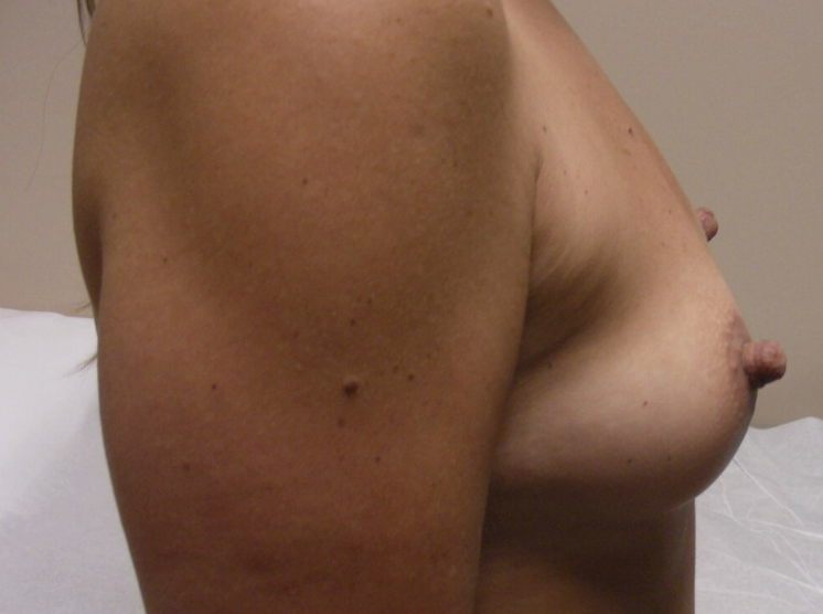 Breast Augmentation before and after - before