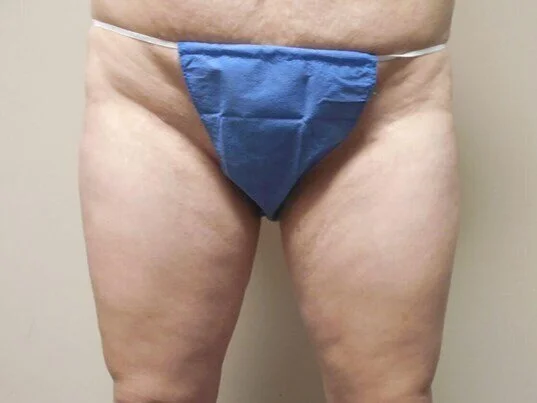 Liposuction before and after - before