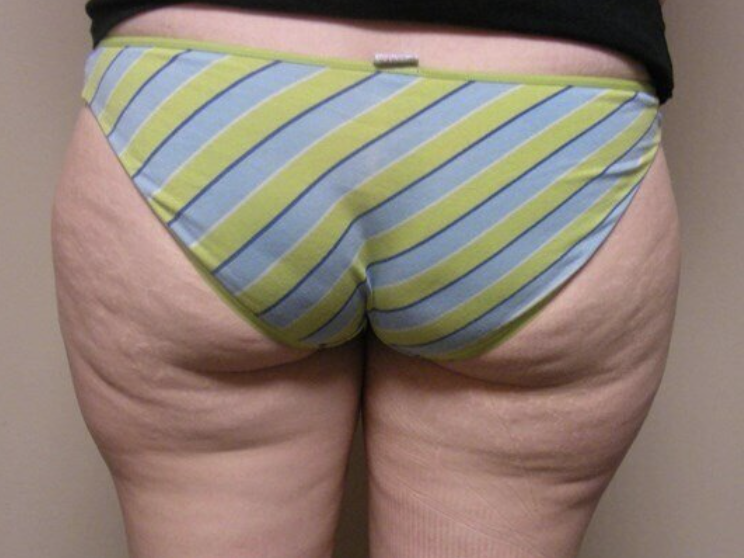 Liposuction before and after - before