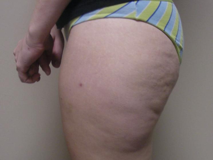 Liposuction before and after - before