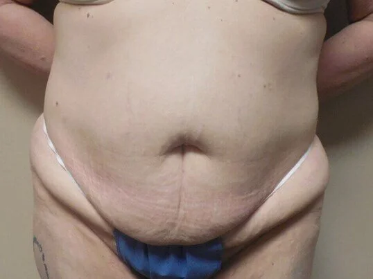 Tummy Tuck before and after - before