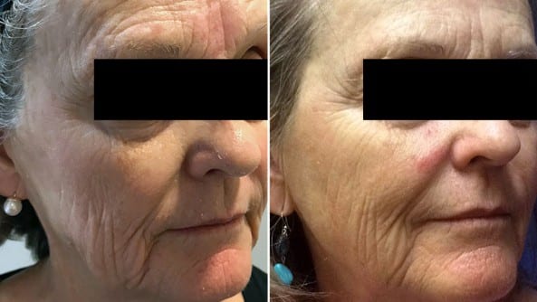 Moxi + BBL Photofacial before and after - after