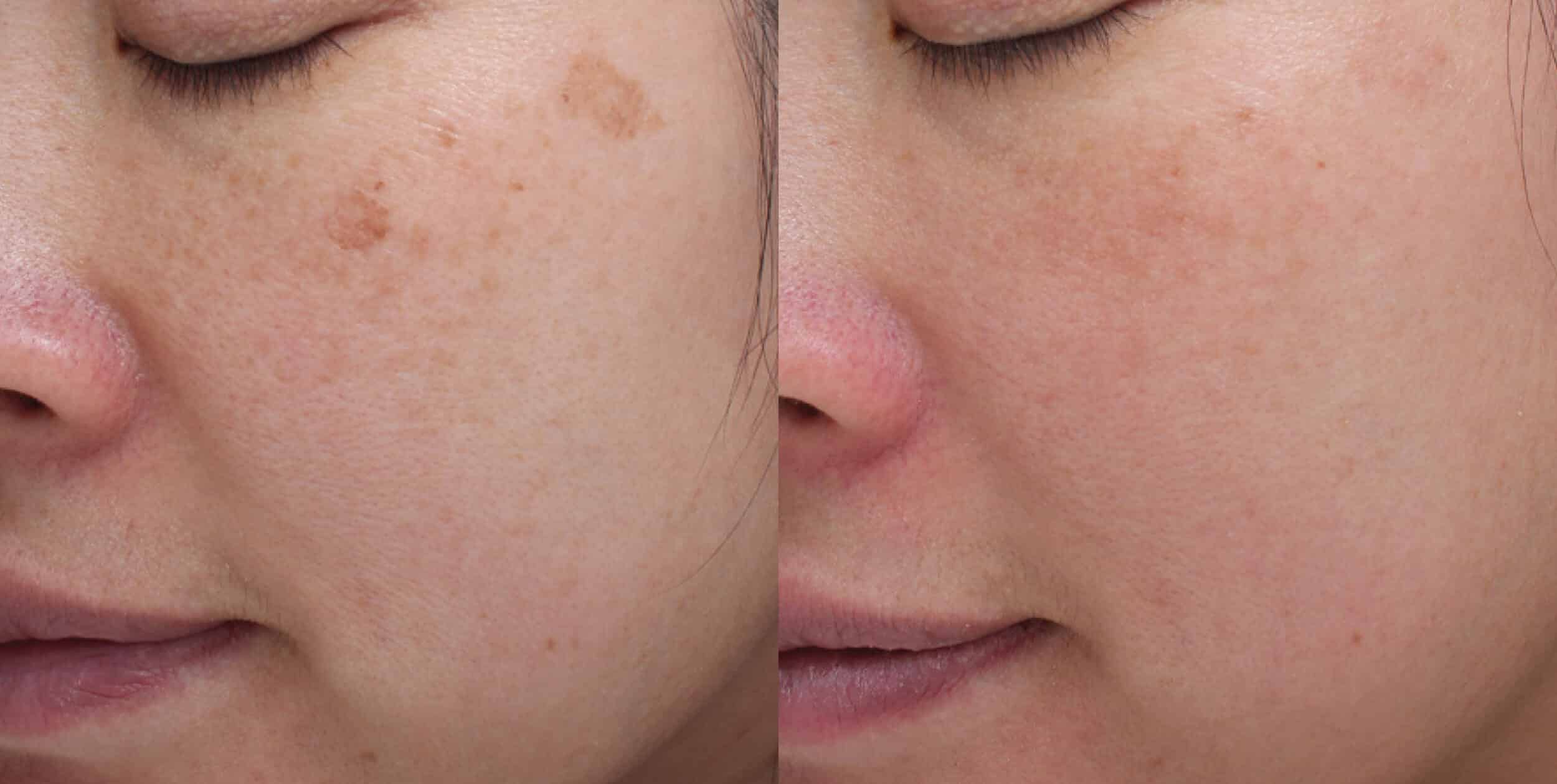 Moxi + BBL Photofacial before and after - before