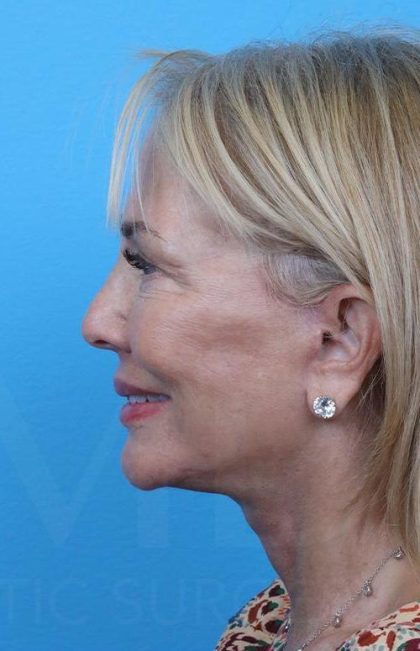 Facelift before and after - after