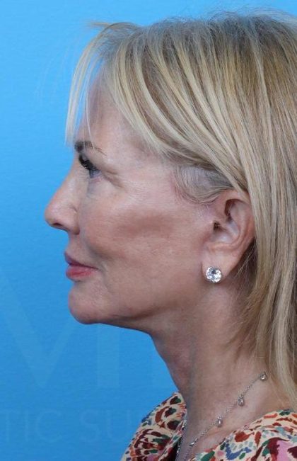 Facelift before and after - after