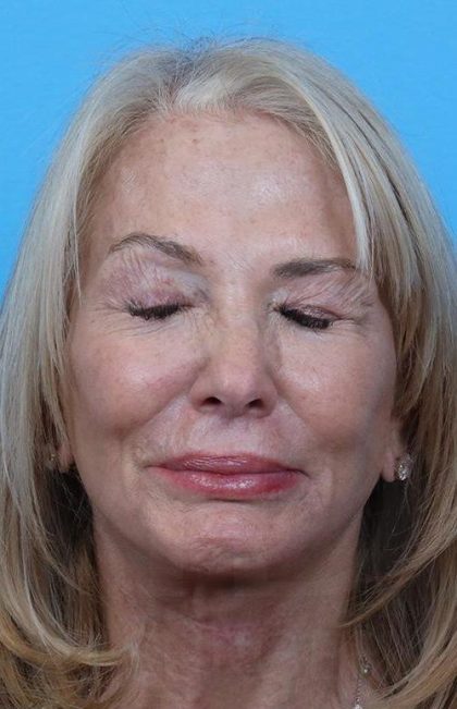 Facelift before and after - after