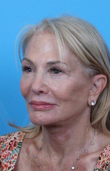 Facelift before and after - after
