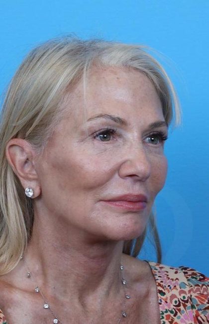 Facelift before and after - after