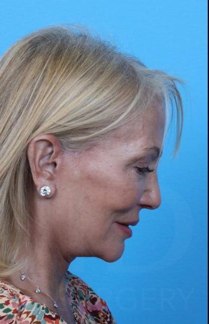 Facelift before and after - after