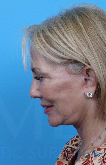 Facelift before and after - after