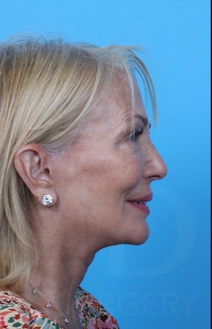 Facelift before and after - after