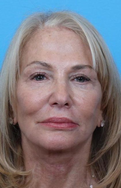 Facelift before and after - after