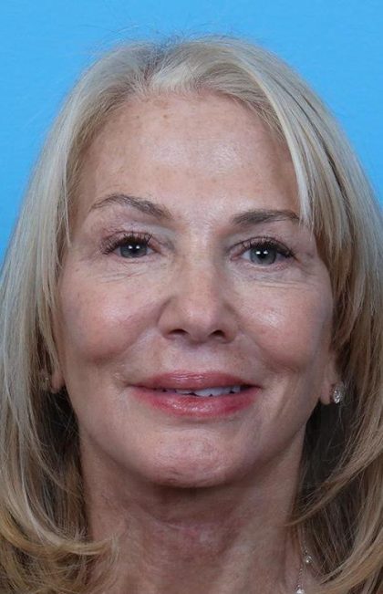 Facelift before and after - after