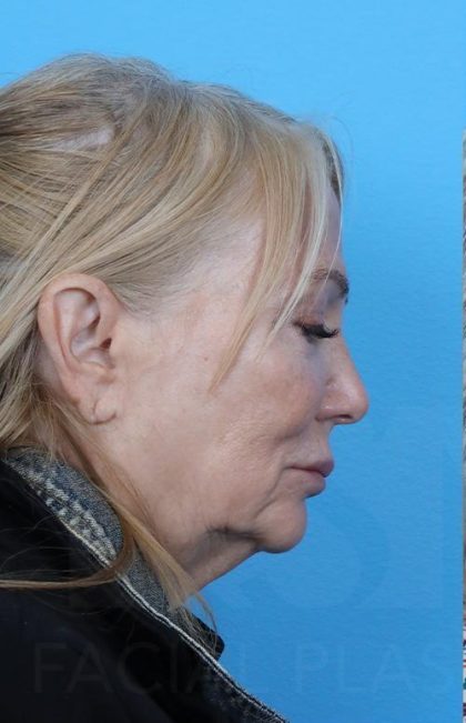 Facelift before and after - before