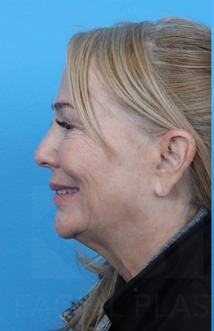 Facelift before and after - before