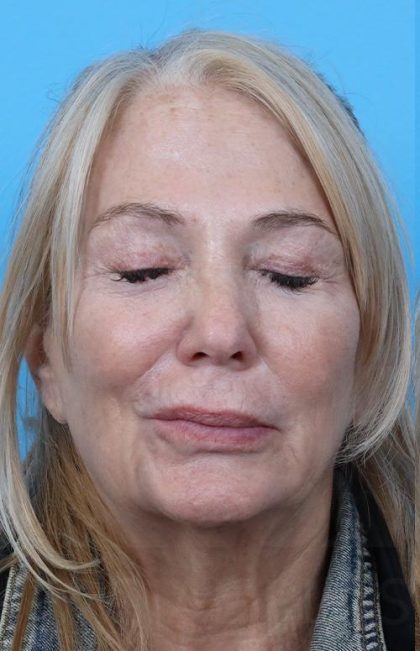 Facelift before and after - before