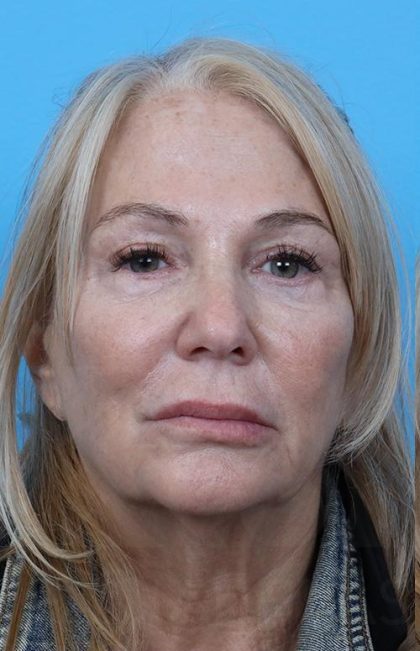 Facelift before and after - before