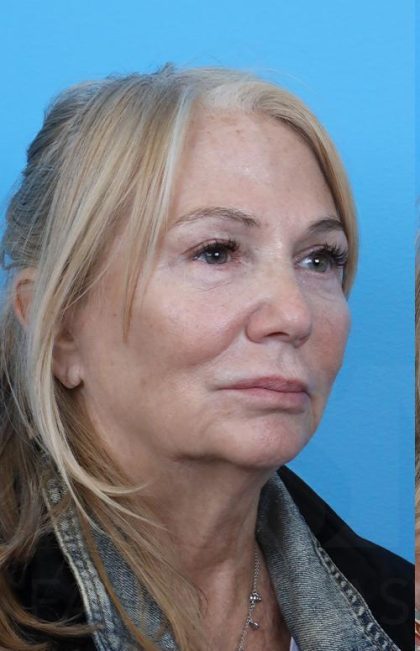 Facelift before and after - before