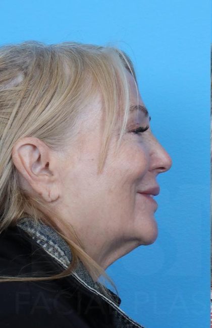 Facelift before and after - before