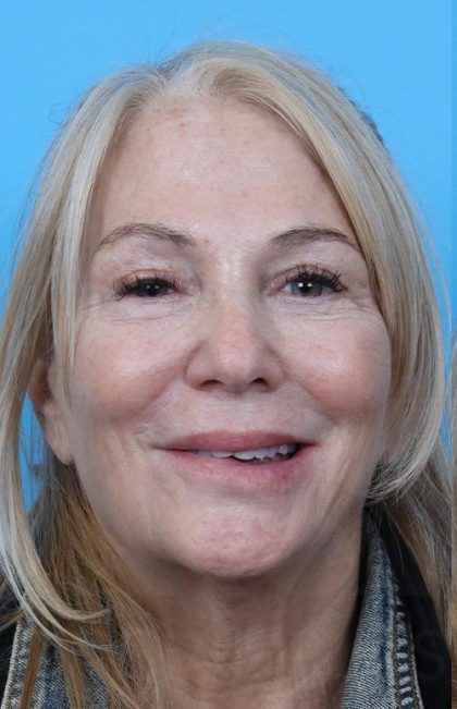 Facelift before and after - before