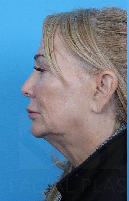 Facelift before and after - before