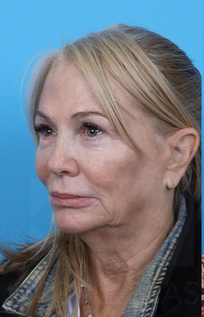 Facelift before and after - before