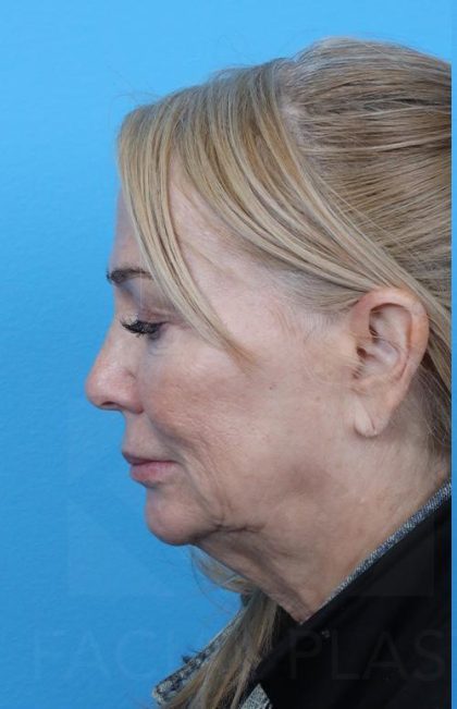 Facelift before and after - before