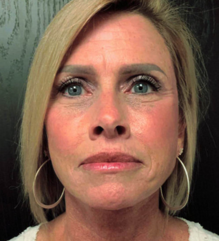 Facelift before and after - after