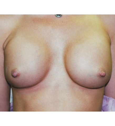 Breast Augmentation before and after - after