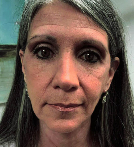 Facelift before and after - after