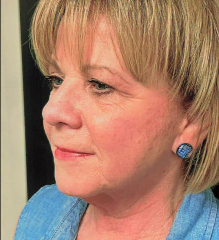 Facelift before and after - after