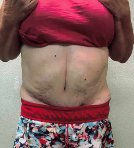 Tummy Tuck before and after - after