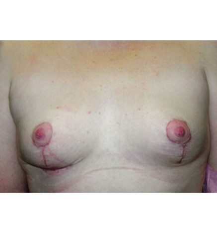 Breast Lift before and after - after