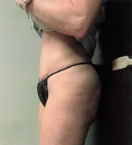 Tummy Tuck before and after - after