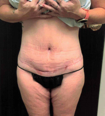Tummy Tuck before and after - after