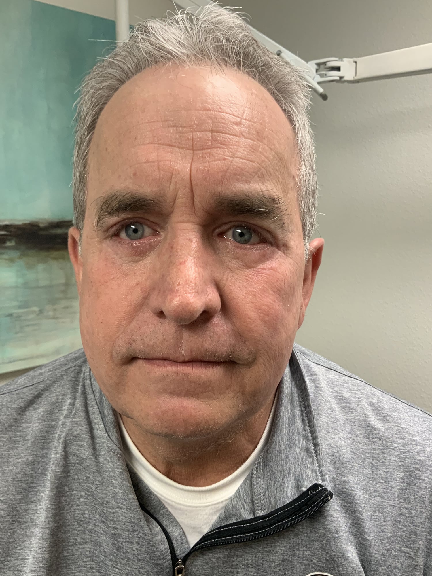 Procedure before and after - after