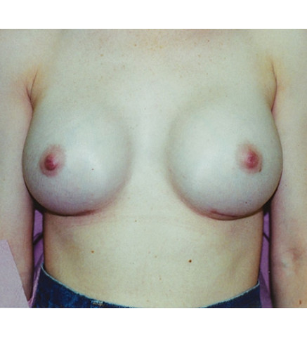 Breast Augmentation before and after - after