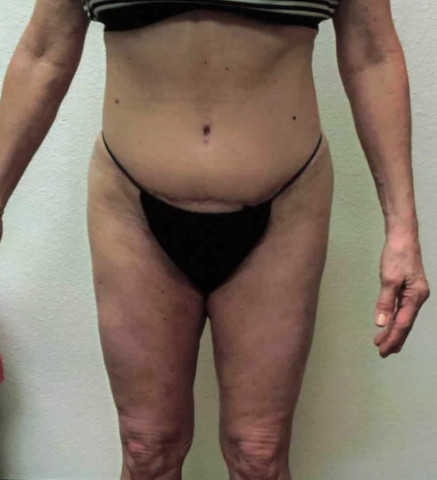 Tummy Tuck before and after - after
