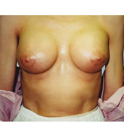 Breast Augmentation before and after - after