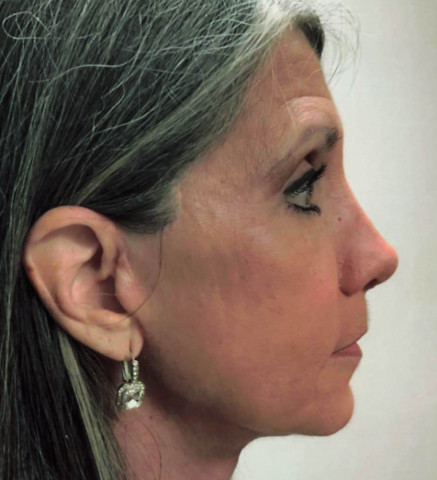Facelift before and after - after