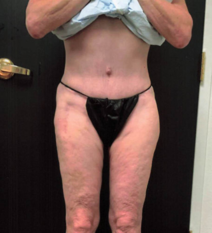 Liposuction before and after - after