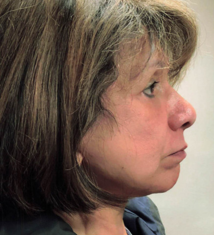 Facelift before and after - after