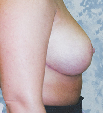 Breast Lift before and after - after