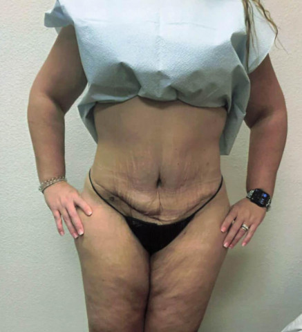 Tummy Tuck before and after - after