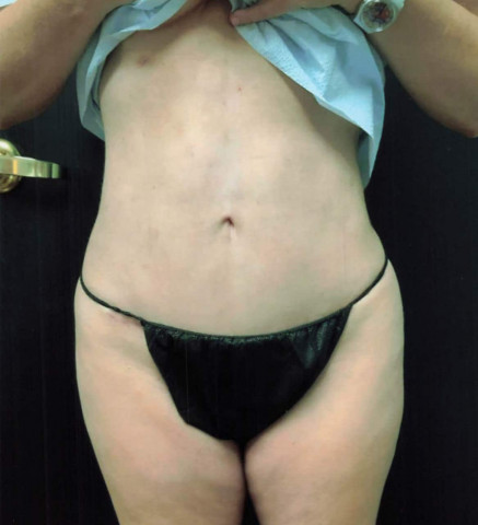 Tummy Tuck before and after - after