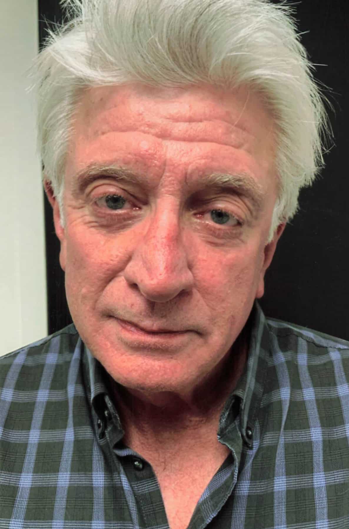 Lower Blepharoplasty before and after - after