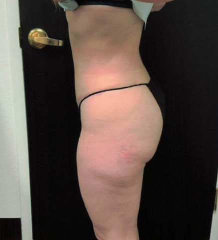 Liposuction before and after - after