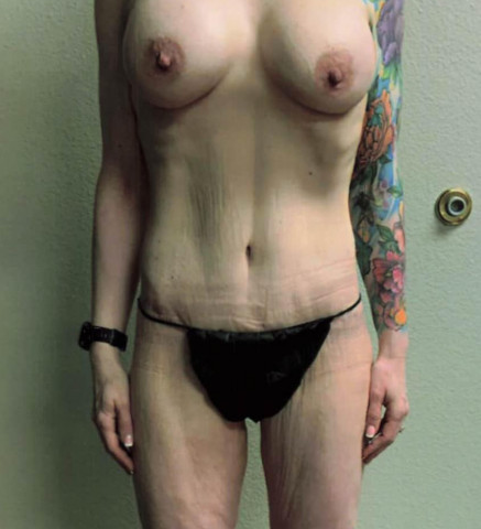 Mommy Makeover before and after - after