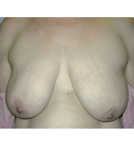 Breast Lift before and after - before