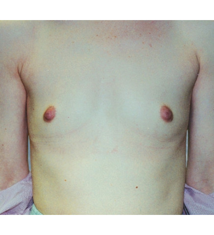 Breast Augmentation before and after - before